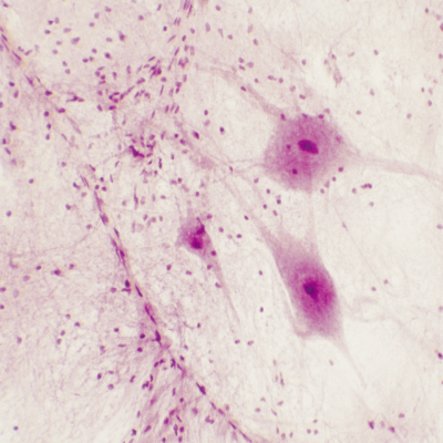 Le neoplasie mieloproliferative